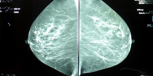 VOUS ALLEZ AVOIR UNE MAMMOGRAPHIE