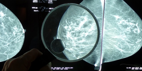 MAMMOGRAPHIE DE DÉPISTAGE