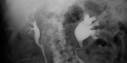 VOUS ALLEZ AVOIR UNE UROGRAPHIE INTRA-VEINEUSE