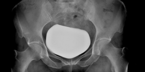 VOUS ALLEZ PASSER UNE CYSTOGRAPHIE