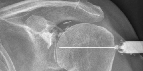 VOUS ALLEZ PASSER UNE ARTHROGRAPHIE – ARTHRO-SCANNER