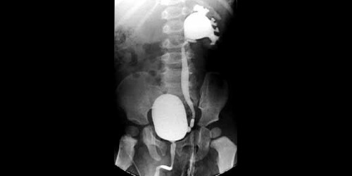 VOTRE ENFANT VA AVOIR UNE CYSTOGRAPHIE RÉTROGRADE