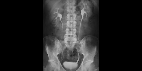 VOTRE ENFANT VA AVOIR UNE UROGRAPHIE
